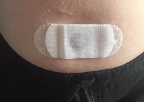 ACElok Dressing for ACE Stopper Plug 10-Pack